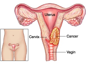 bilan-santé-50-ans-humains-cancer-col-de-utérus