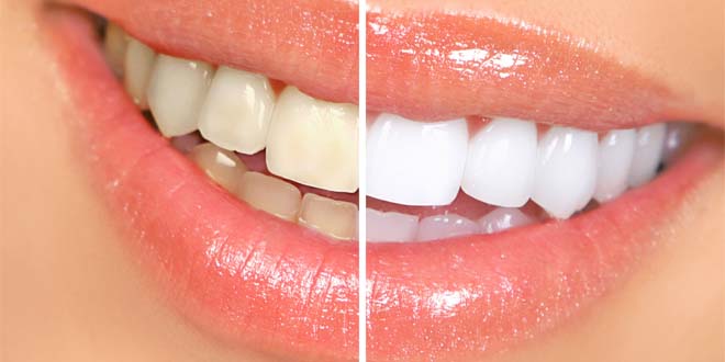 blanchiment-dentaire-des-raisons-de-le-faire-chez-votre-dentiste